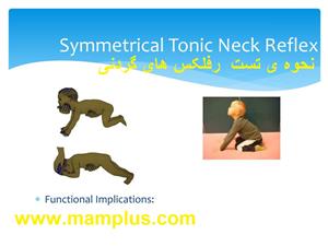 symmetrical-tonic-neck-reflex-l.jpg
